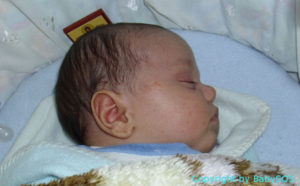 Baby mit Hitzepickeln im Gesicht