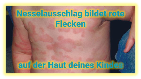 Nesselausschlag Kleinkind – Rote Flecken Nesselausschlag Kleinkind - Rote Flecken